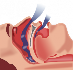 Obstructive sleep apnea (OSA) is caused by obstruction of the upper airway and is characterized by repetitive pauses in breathing during sleep, despite the effort to breathe. It is also usually associated with a reduction in blood oxygen saturation.